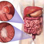 El consumo excesivo de carne roja y conservas incide en la aparición de cáncer de colon